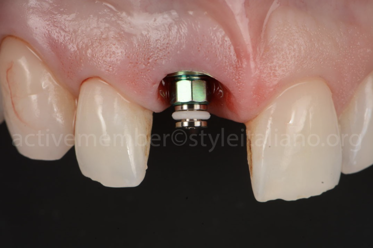 Phục hình thẩm mỹ răng cửa bằng sự kết hợp giữa Veneer và implant